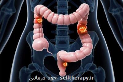 غربالگری سرطان روده بزرگ باید از ۴۵ سالگی شروع شود