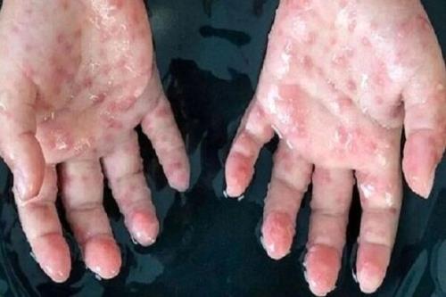 یک فرد مبتلا به علایم آبله میمون در بابل شناسایی شد