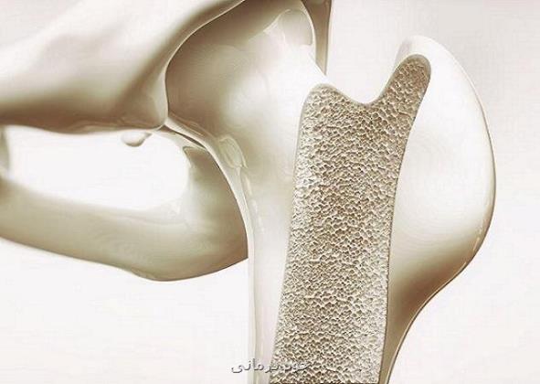 هورمون درمانی به پیش گیری از پوکی استخوان کمک می کند