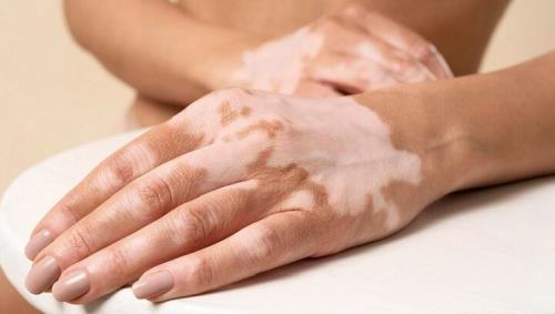 جدیدترین سفارش های پزشکی برای کنترل لک های پوستی