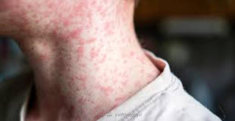 آمار مبتلا شدن به سرخک در سه ماه اول سال