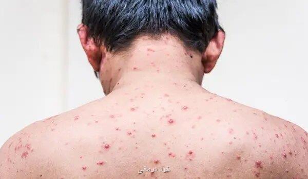علایم آبله مرغان در بزرگسالان