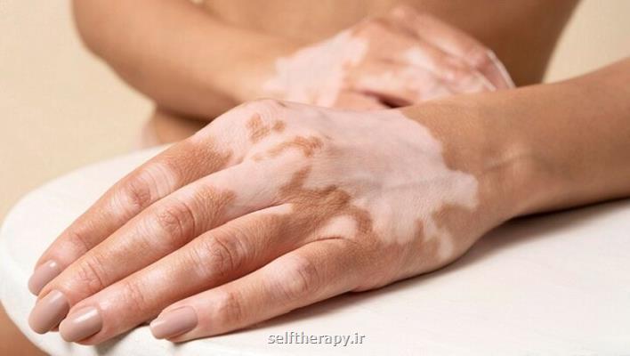 جدیدترین سفارش های پزشکی برای کنترل لک های پوستی