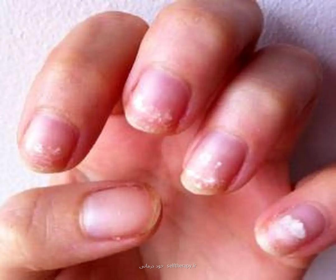 روش تشخیص کم خونی از روی پوست دست