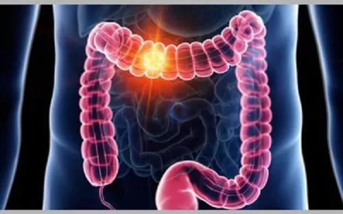 عوامل موثر در بروز سرطان روده