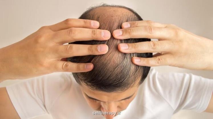 این داروی درمان ریزش مو موجب ایجاد افکار خودکشی می شود