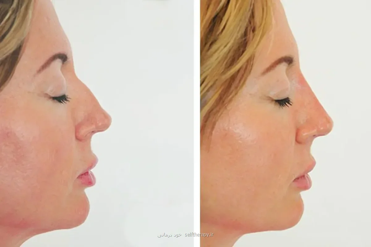 فیلر بینی و هر آنچه پیش از تزریق باید بدانید