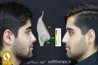 جراحی بینی با قالب كنترلی